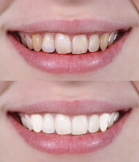 Lambourne Family Dental perfect teeth 01